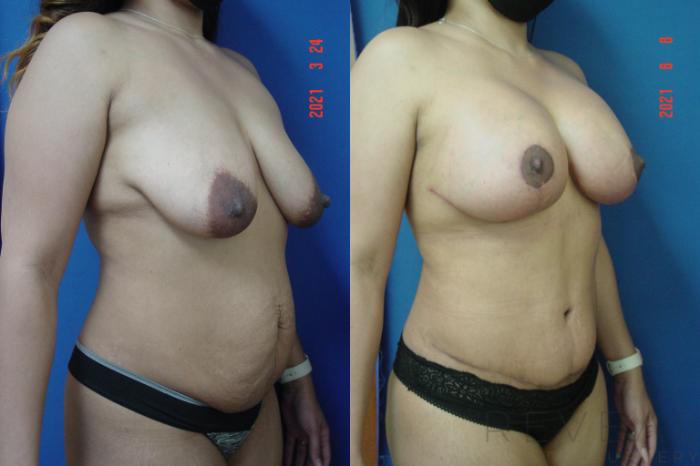 Before & After Breast Lift Case 565 View #2 View in San Jose, CA