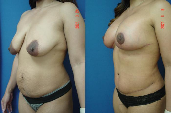 Before & After Breast Lift Case 565 View #3 View in San Jose, CA