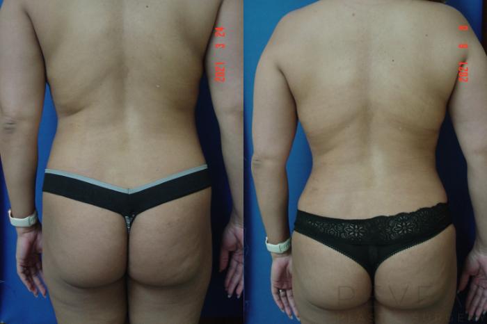 Before & After Liposuction Case 565 View #4 View in San Jose, CA