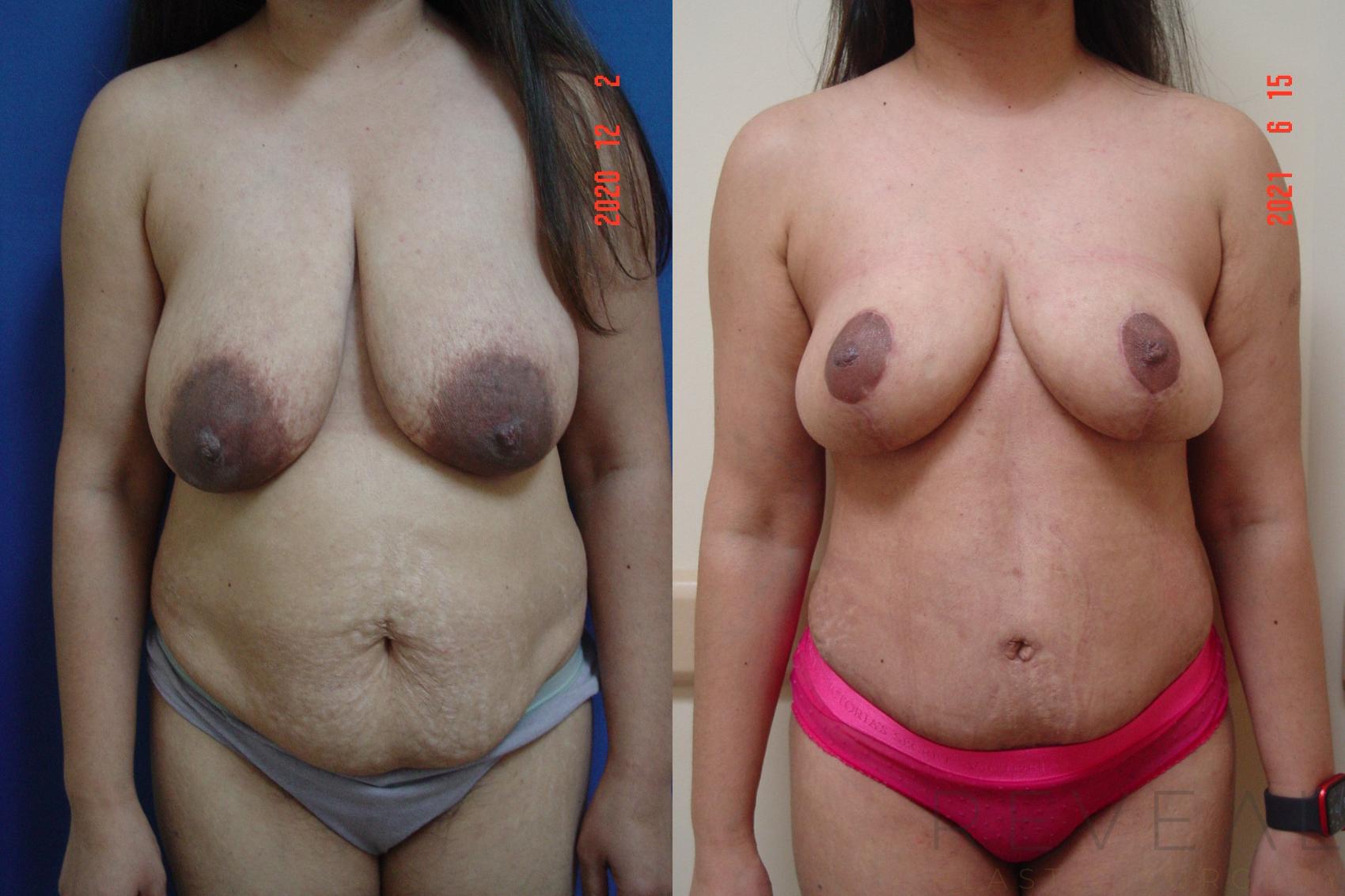 Before & After Breast Reduction Case 567 View #1 View in San Jose, CA