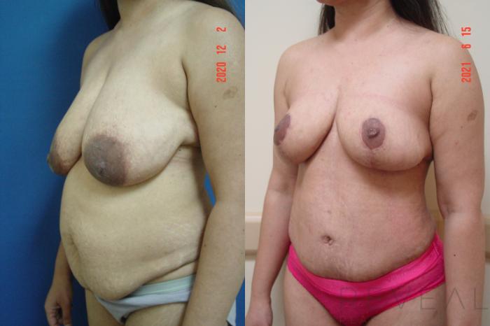 Before & After Liposuction Case 567 View #2 View in San Jose, CA