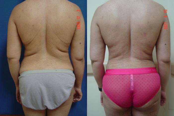 Before & After Breast Reduction Case 567 View #4 View in San Jose, CA