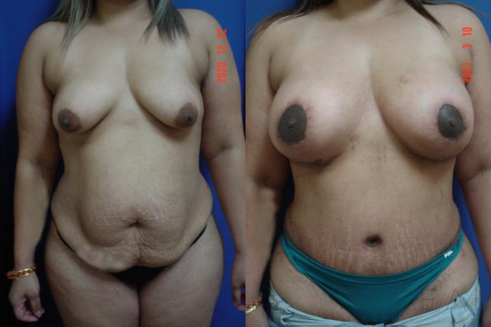 Before & After Breast Augmentation Case 570 View #1 View in San Jose, CA