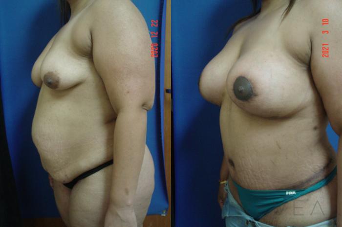 Before & After Breast Augmentation Case 570 View #2 View in San Jose, CA