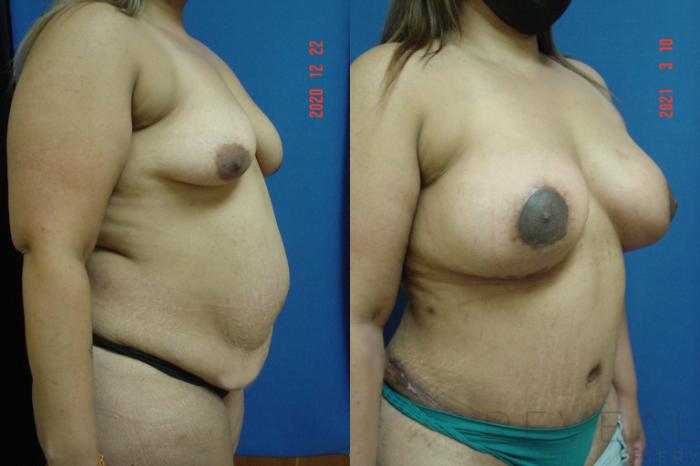 Before & After Breast Augmentation Case 570 View #3 View in San Jose, CA
