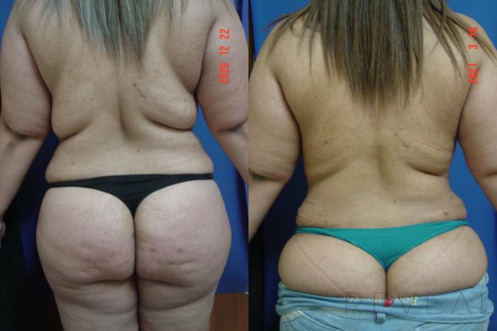 Before & After Liposuction Case 570 View #4 View in San Jose, CA