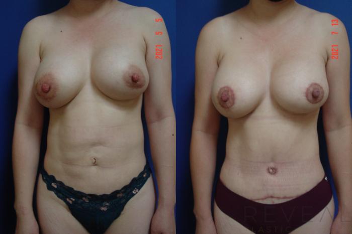 Before & After Liposuction Case 573 View #1 View in San Jose, CA