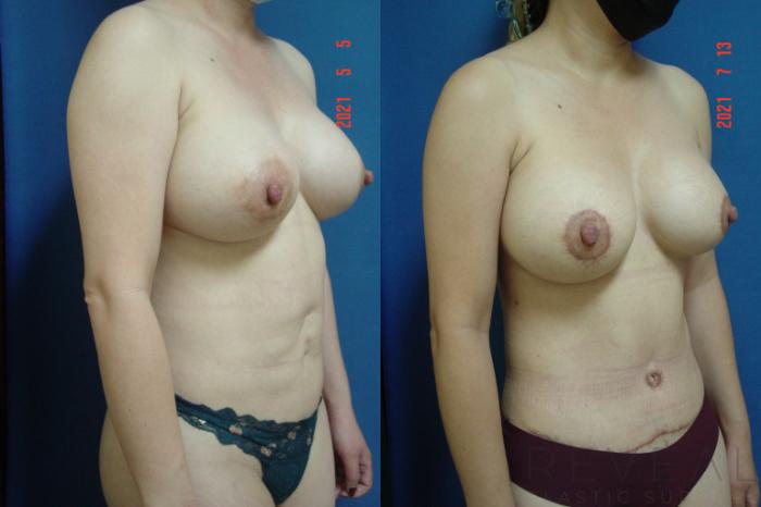 Before & After Liposuction Case 573 View #2 View in San Jose, CA