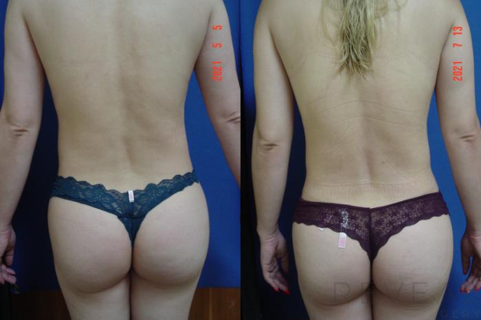 Before & After Liposuction Case 573 View #3 View in San Jose, CA