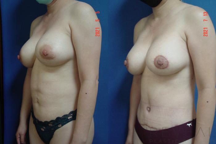 Before & After Liposuction Case 573 View #4 View in San Jose, CA