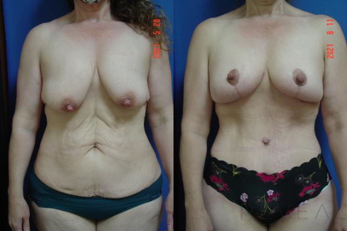 Before & After Breast Lift Case 575 View #1 View in San Jose, CA