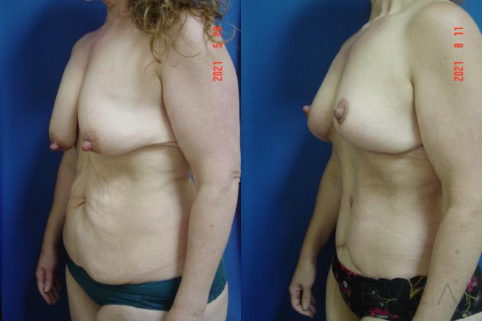 Before & After Breast Lift Case 575 View #2 View in San Jose, CA