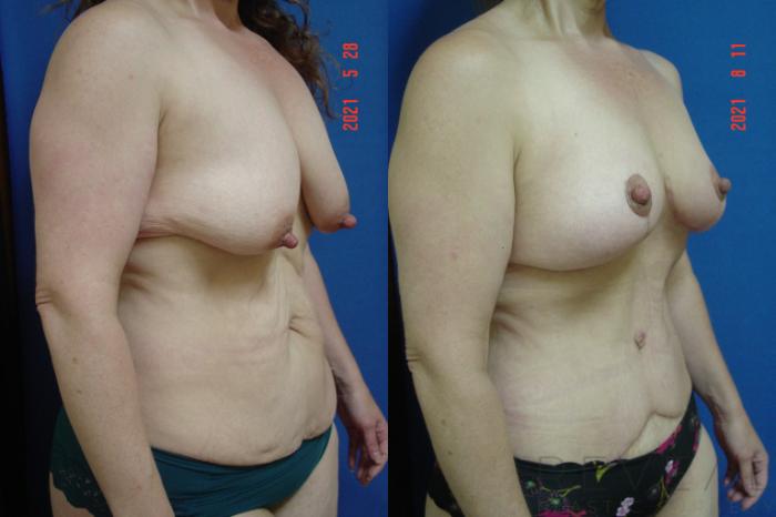 Before & After Tummy Tuck Case 575 View #3 View in San Jose, CA