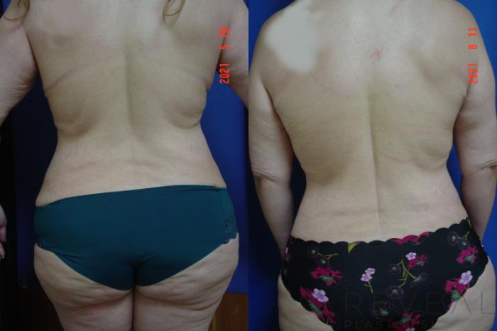 Before & After Tummy Tuck Case 575 View #4 View in San Jose, CA