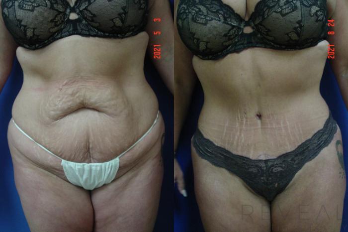 Before & After Tummy Tuck Case 577 View #1 View in San Jose, CA