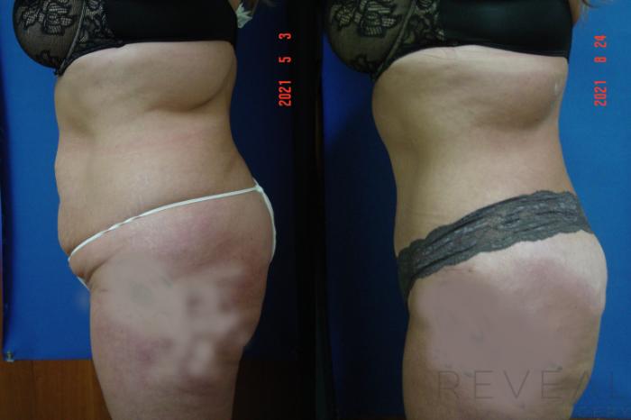 Before & After Tummy Tuck Case 577 View #2 View in San Jose, CA