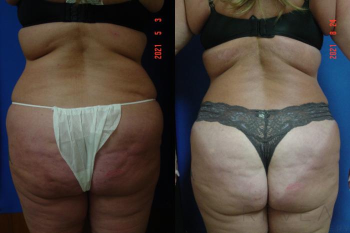 Before & After Tummy Tuck Case 577 View #3 View in San Jose, CA