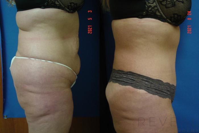 Before & After Tummy Tuck Case 577 View #4 View in San Jose, CA