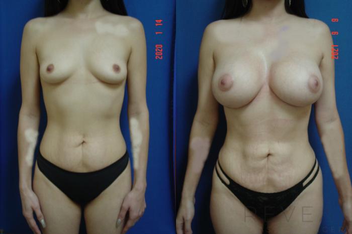 Before & After Liposuction Case 591 View #1 View in San Jose, CA