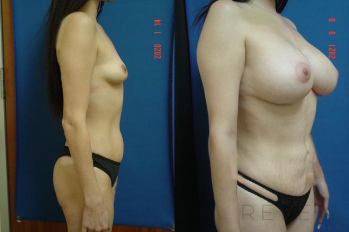 Before & After Breast Augmentation Case 591 View #3 View in San Jose, CA