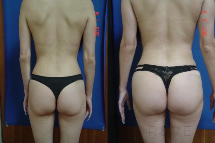 Before & After Brazilian Butt Lift Case 591 View #4 View in San Jose, CA