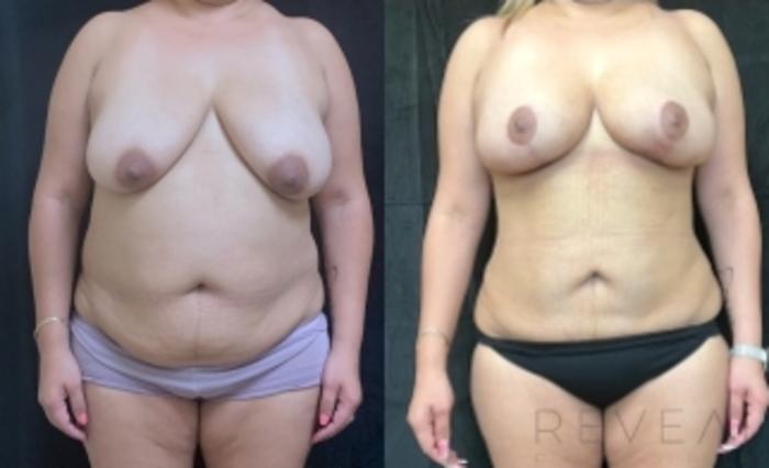 Before & After Breast Lift Case 600 Front View in San Jose, CA
