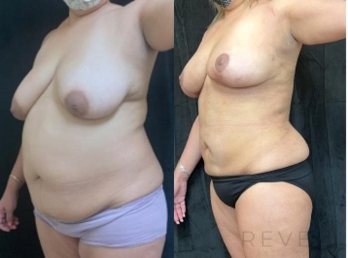 Before & After Liposuction Case 600 Left Oblique View in San Jose, CA