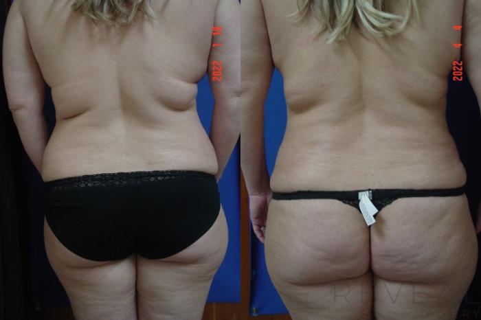 Before & After Tummy Tuck Case 632 Back View in San Jose, CA
