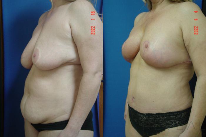 Before & After Breast Augmentation Case 632 Left Side View in San Jose, CA