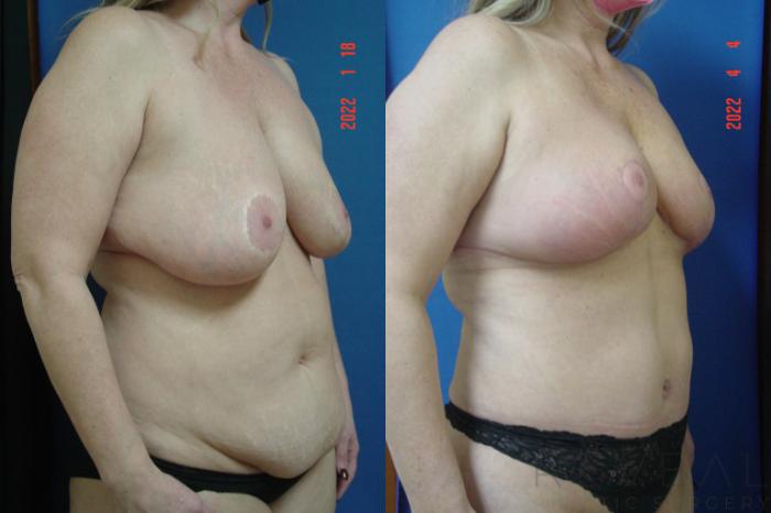 Before & After Breast Augmentation Case 632 Right Side View in San Jose, CA