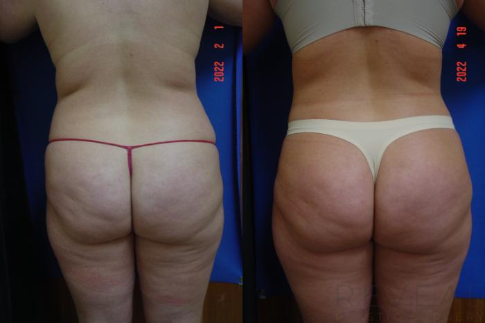 Before & After Tummy Tuck Case 634 Back View in San Jose, CA