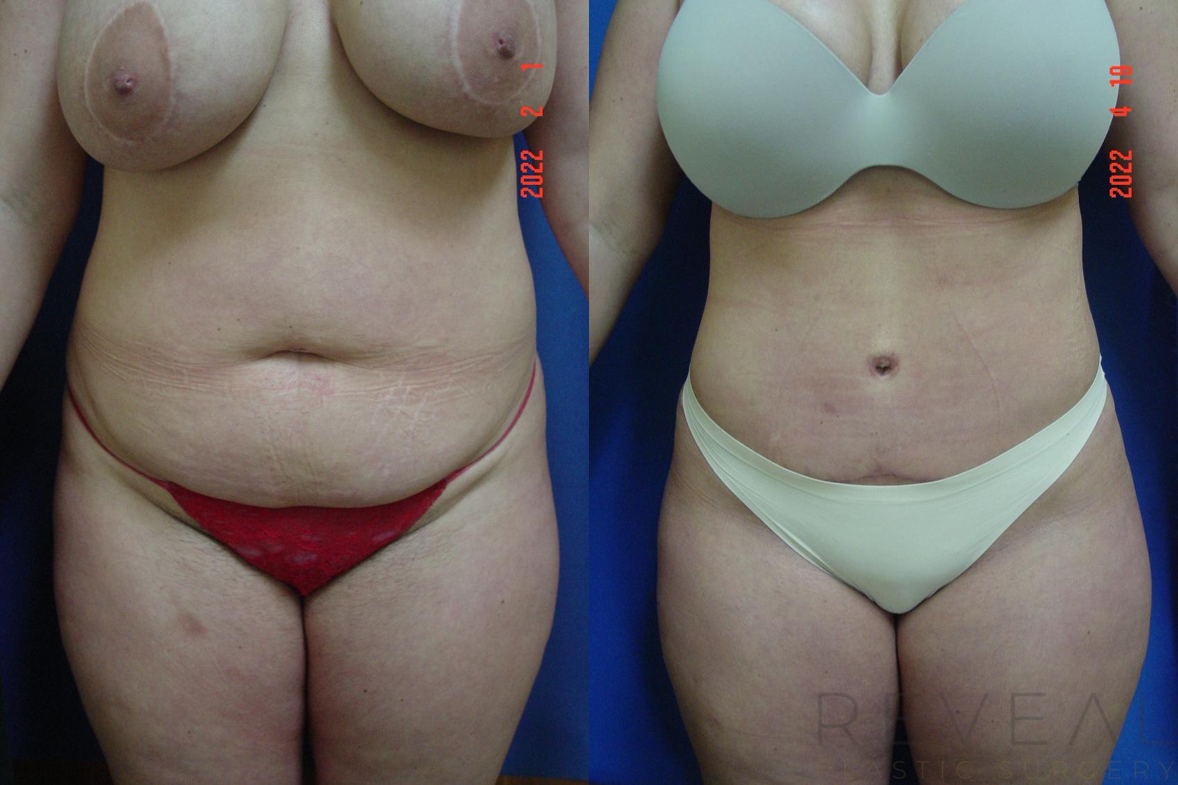 Before & After Tummy Tuck Case 634 Front View in San Jose, CA