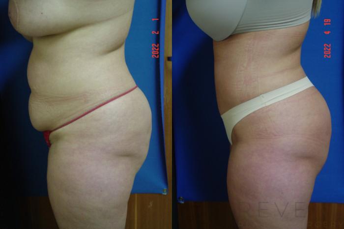 Before & After Tummy Tuck Case 634 Left Side View in San Jose, CA