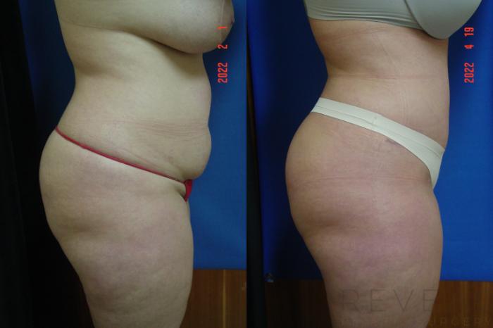 Before & After Tummy Tuck Case 634 Right Side View in San Jose, CA