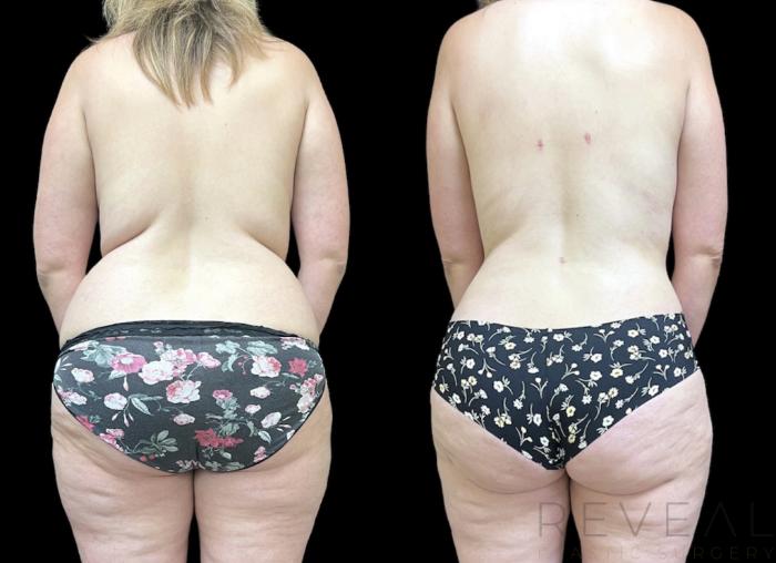 Before & After Mommy Makeover Case 648 Back View in San Jose, CA