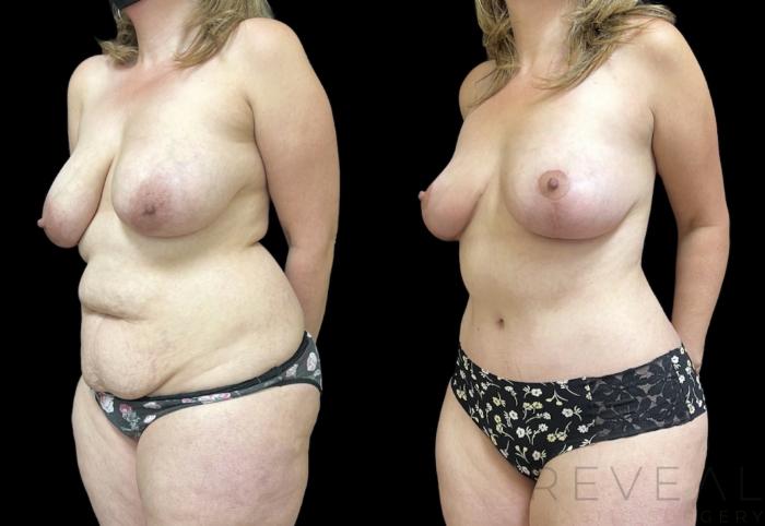 Before & After Mommy Makeover Case 648 Right Oblique View in San Jose, CA