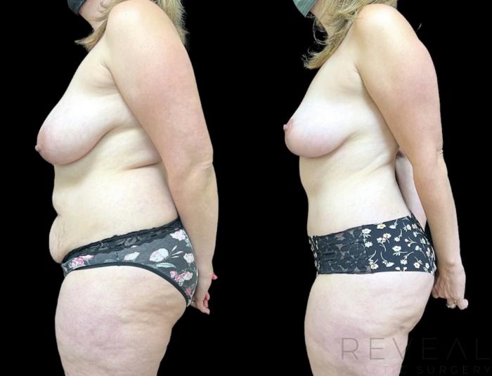 Before & After Mommy Makeover Case 648 Right Side View in San Jose, CA