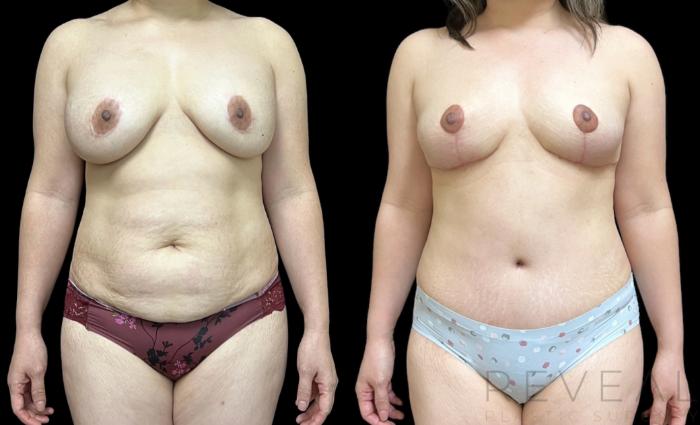 Before & After Tummy Tuck Case 652 Front View in San Jose, CA