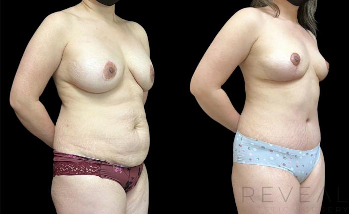 Before & After Breast Implants Case 652 Left Side View in San Jose, CA