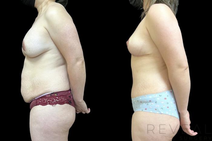 Before & After Liposuction Case 652 Right Oblique View in San Jose, CA
