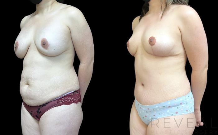 Before & After Liposuction Case 652 Right Side View in San Jose, CA