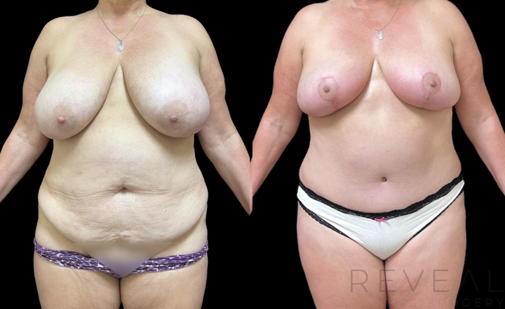 Before & After Liposuction Case 653 Front View in San Jose, CA