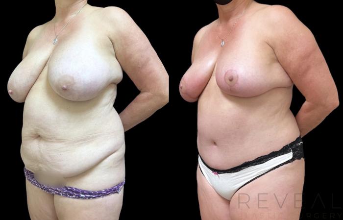 Before & After Liposuction Case 653 Right Side View in San Jose, CA