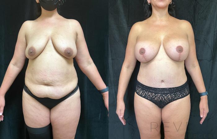 Before & After Tummy Tuck Case 688 Front View in San Jose, CA