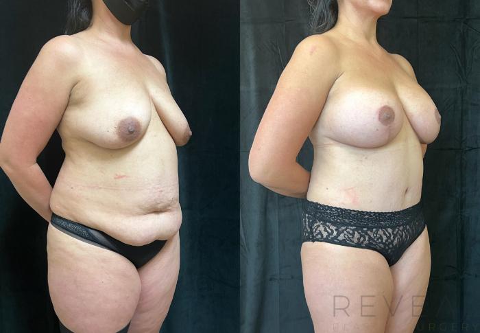 Before & After Tummy Tuck Case 688 Left Oblique View in San Jose, CA