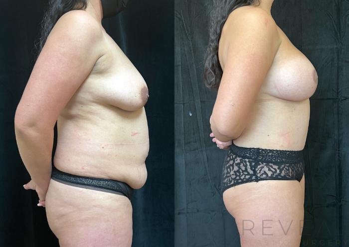 Before & After Breast Lift Case 688 Left Side View in San Jose, CA