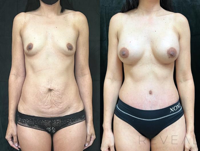 Before & After Tummy Tuck Case 702 Front View in San Jose, CA