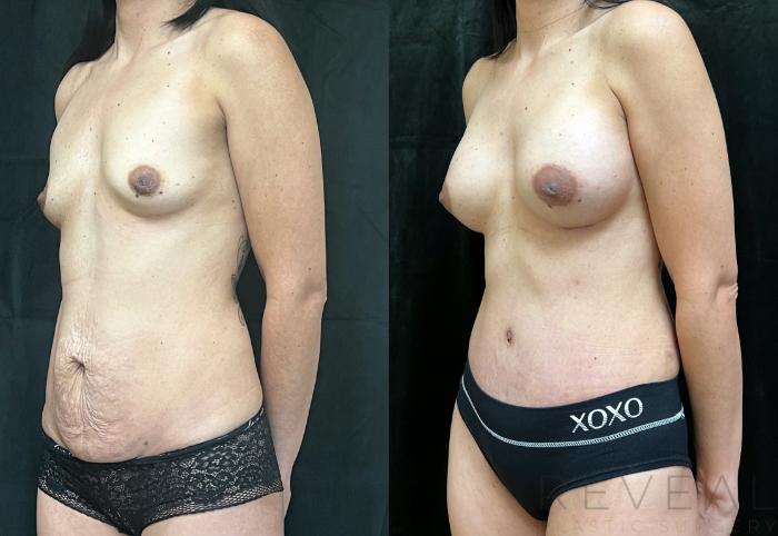 Before & After Tummy Tuck Case 702 Right Oblique View in San Jose, CA