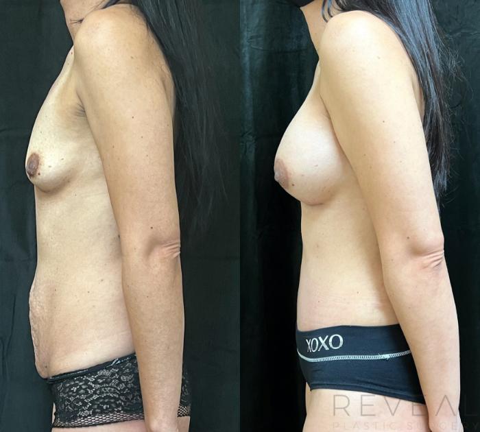 Before & After Tummy Tuck Case 702 Right Side View in San Jose, CA