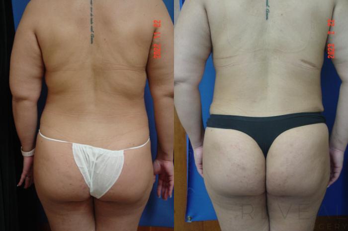 Before & After Tummy Tuck Case 722 Back View in San Jose, CA